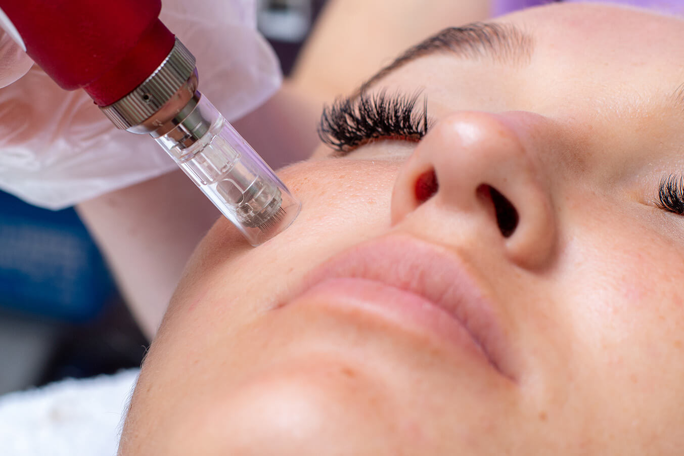 Microneedling procedure in escape at the spa in Mississauga