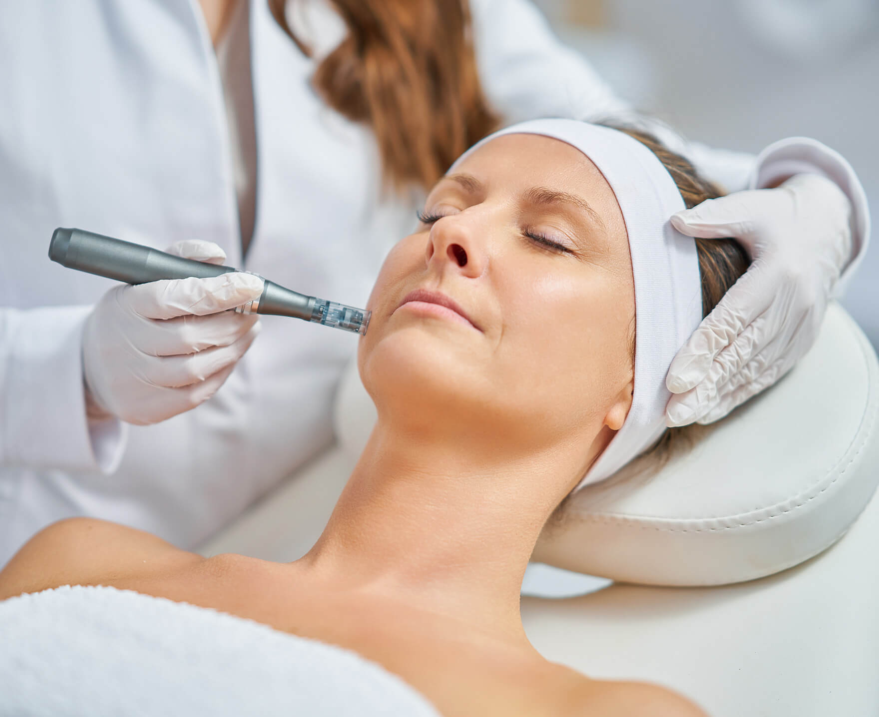 Mississauga Streetsville spa microneedling