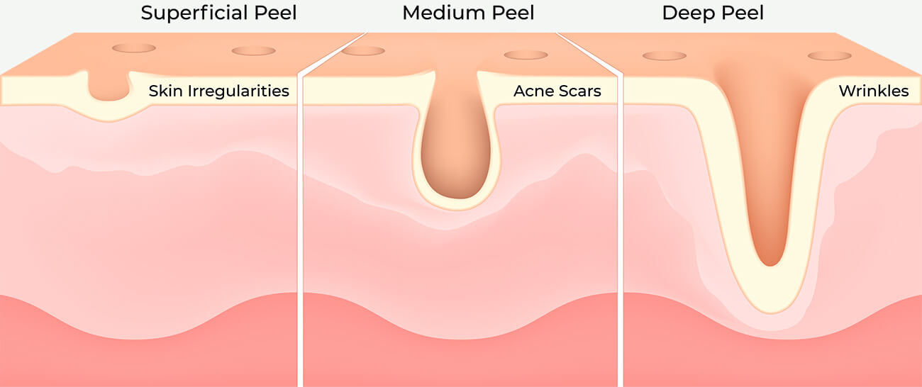 chemical peel infographic