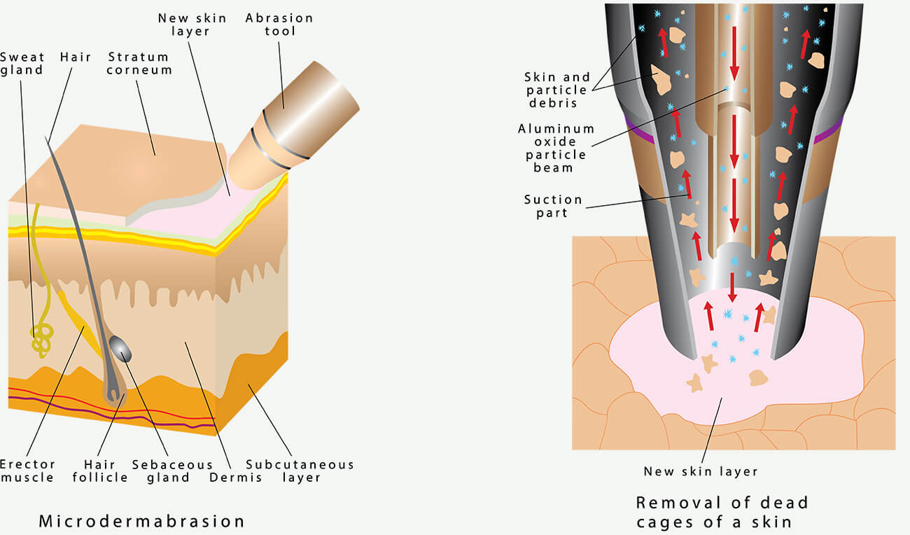 microdermabrasion infographic