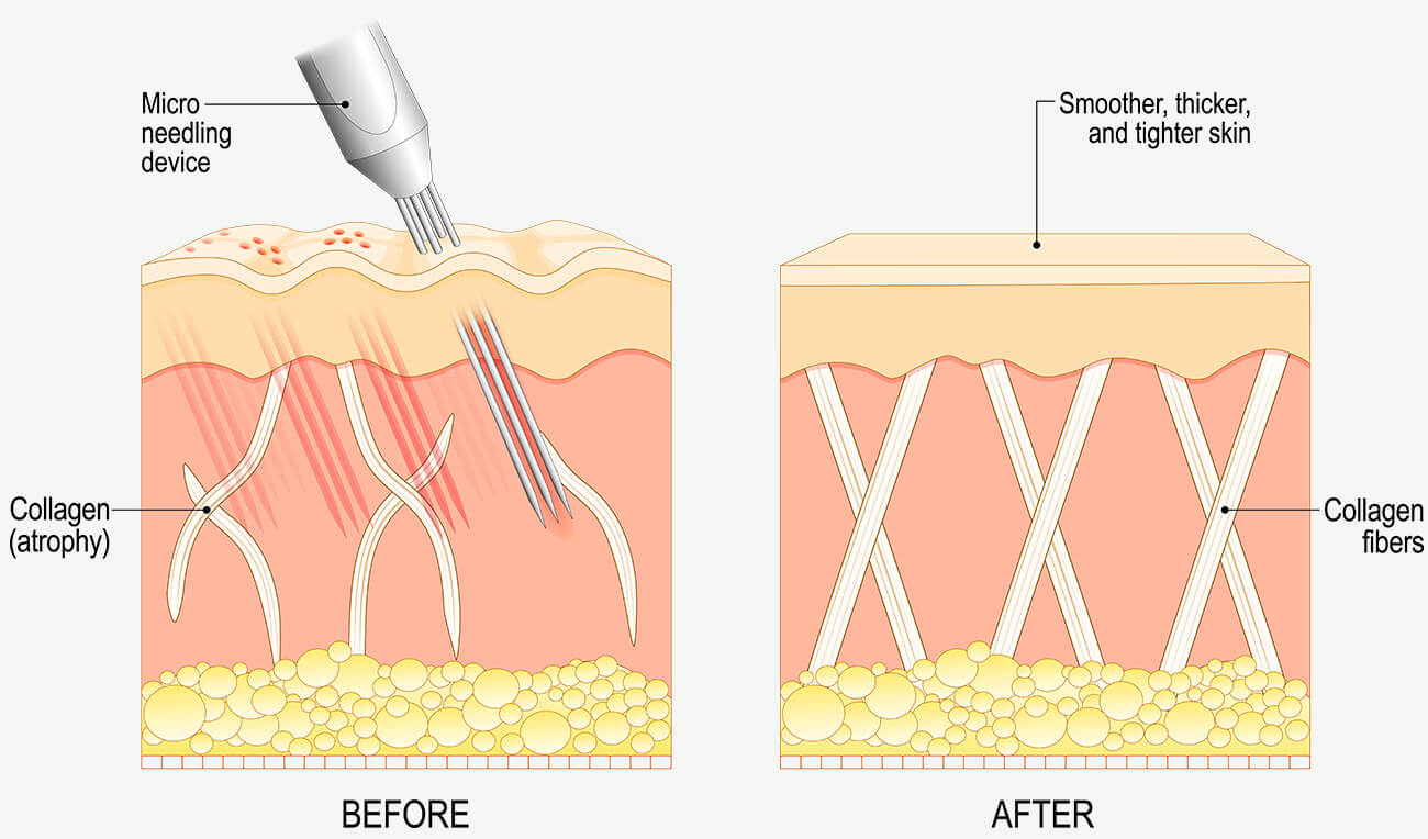 microneedling infographic